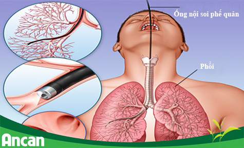 Phương pháp phổ biến trong chẩn đoán ung thư phổi hiện nay là chụp X-quang lồng ngực