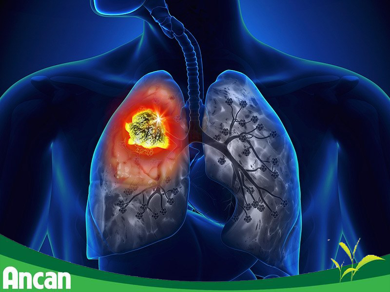 Dấu hiệu nhận biết bệnh ung thư phổi 1