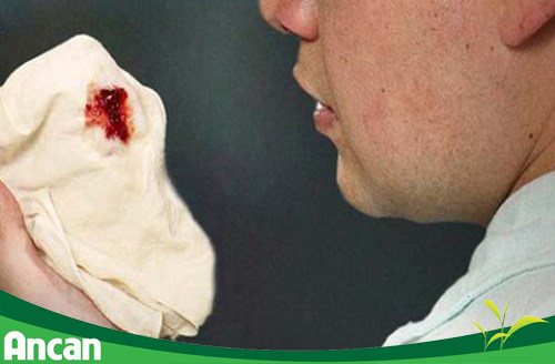 Dấu hiệu nhận biết bệnh ung thư phổi 3