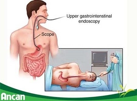 cac-phuong-phap-chan-doan-ung-thu-thuc-quan-3