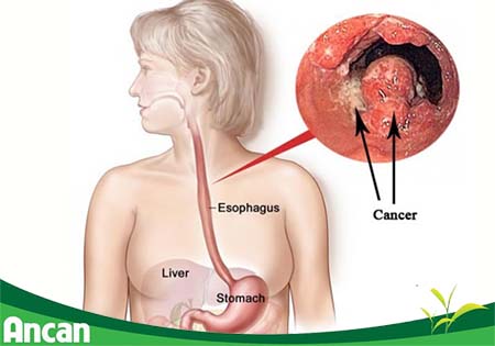 kien-thuc-chung-ve-benh-ung-thu-thuc-quan-1