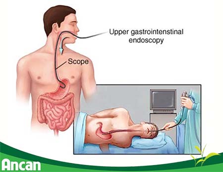 kien-thuc-chung-ve-benh-ung-thu-thuc-quan-4