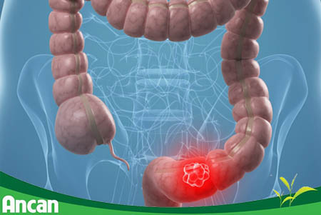 Dấu hiệu nhận biết ung thư trực tràng 1