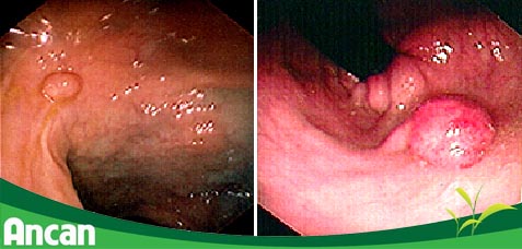 nguyen-nhan-ung-thu-dai-truc-trang-02