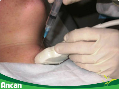 4 phương pháp chẩn đoán ung thư tuyến giáp hiện nay 3