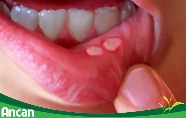 Điều trị ung thư vòm họng bằng hóa trị dễ gây nên các tác dụng phụ 1