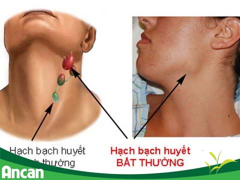 Ung thư vòm họng có chữa khỏi không?1