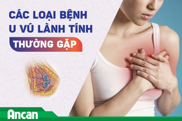 Các loại u vú lành tính thường gặp và cách điều trị