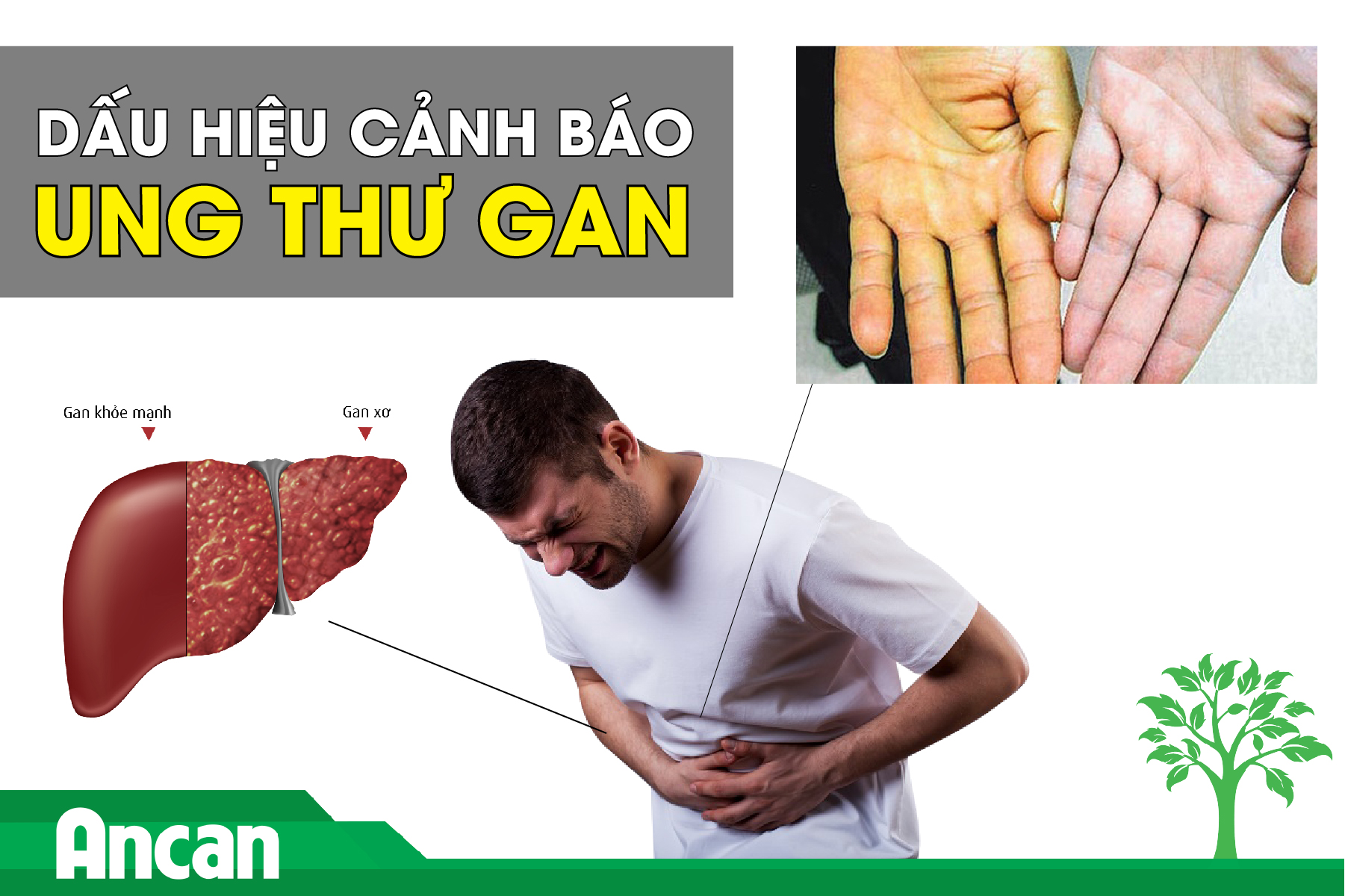 Dấu hiệu cảnh báo sớm bệnh ung thư gan