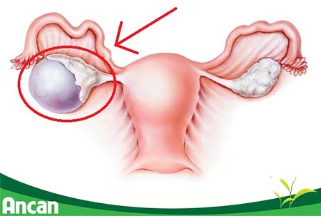 5 nguyên nhân gây u nang buồng trứng