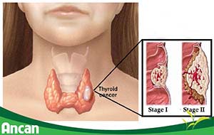 6 dấu hiệu nhận biết bệnh ung thư tuyến giáp