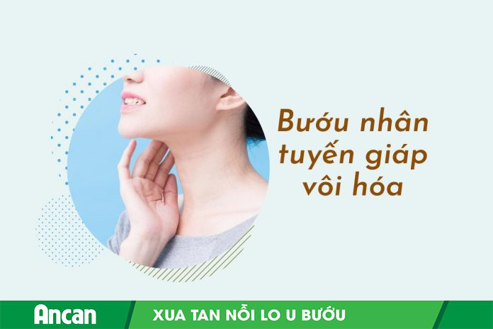 Bướu nhân tuyến giáp vôi hóa và những điều cần biết