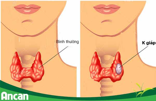 Triệu chứng và dấu hiệu nhận biết bệnh K