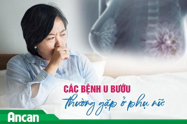 Các bệnh u bướu thường gặp ở phụ nữ