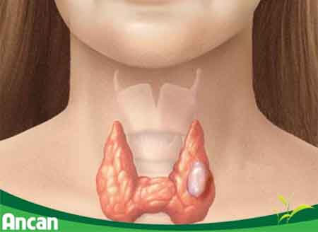 Nguyên nhân và triệu chứng của bệnh u nang tuyến giáp