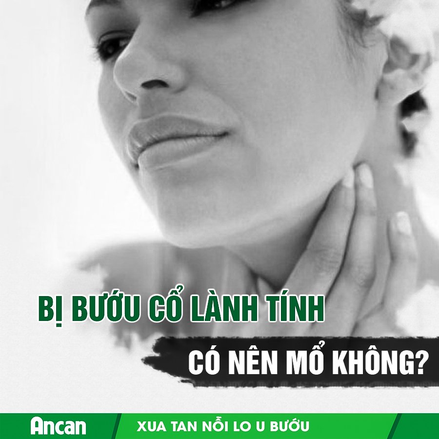 Bướu cổ lành tính - khi nào cần mổ?