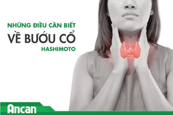 Những điều cần biết về bướu cổ Hashimoto