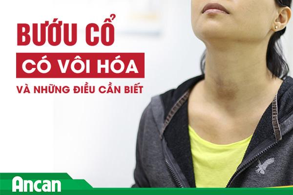 Bướu Cổ Co Voi Hoa Va Những điều Cần Biết