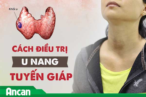 Cách điều trị u nang tuyến giáp hiệu quả