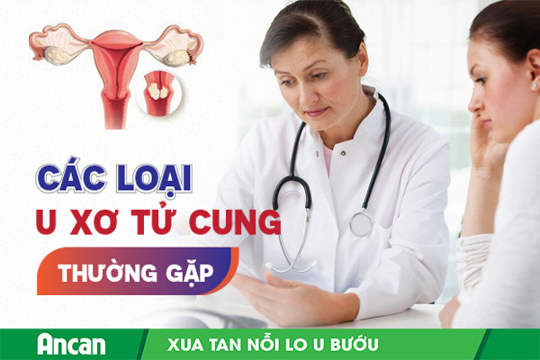 Các loại u xơ tử cung thường gặp