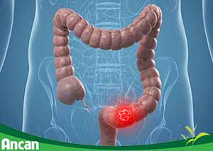 Các phương pháp điều trị ung thư đại tràng giai đoạn 2
