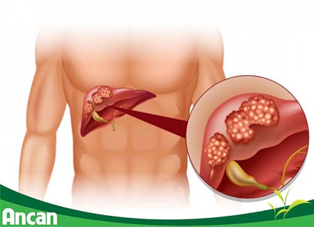Các phương pháp điều trị ung thư gan giai đoạn 3