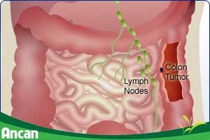 Cách điều trị ung thư đại tràng giai đoạn 3