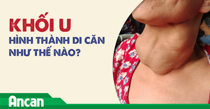 Khối u hình thành di căn như thế nào?