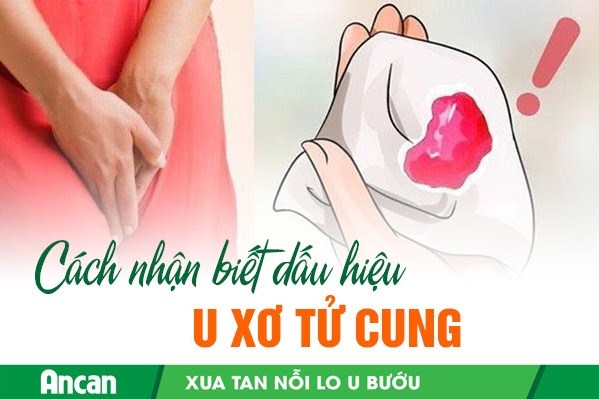 Cách nhận biết dấu hiệu u xơ tử cung