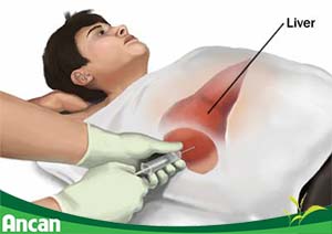 Điều trị ung thư gan giai đoạn cuối