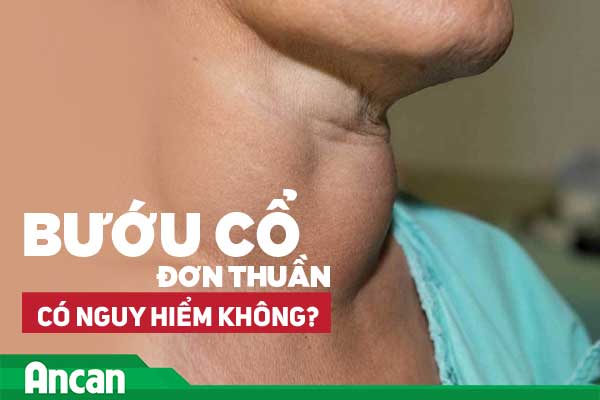 Bướu cổ đơn thuần có nguy hiểm không?