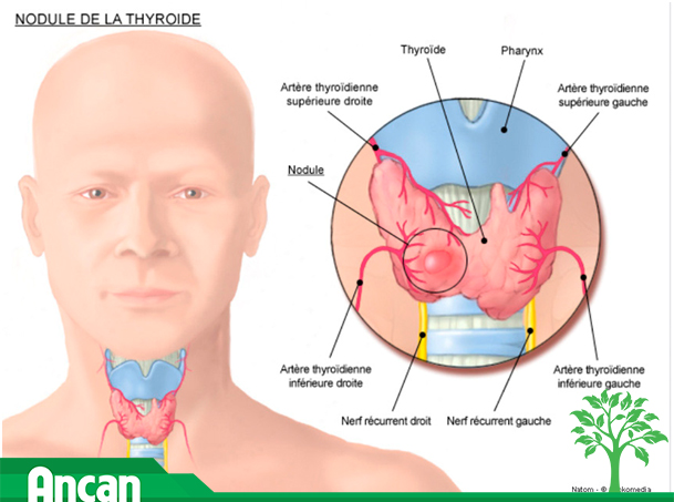 Chế độ ăn cho người bệnh ung thư tuyến giáp