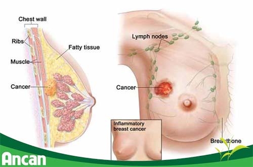 Kiến thức về căn bệnh ung thư vú giai đoạn 1