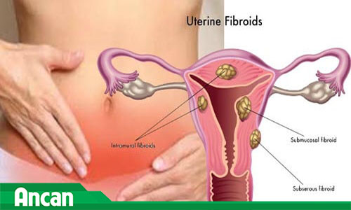 Quy trình mổ u xơ tử cung chị em cần biết