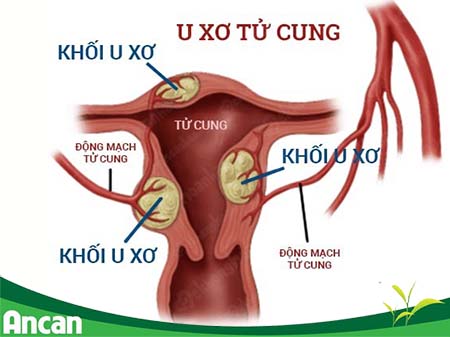 Nguyên nhân gây u xơ tử cung
