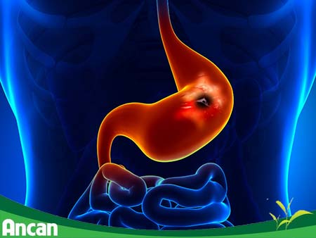 Những điều cần biết về bệnh ung thư dạ dày