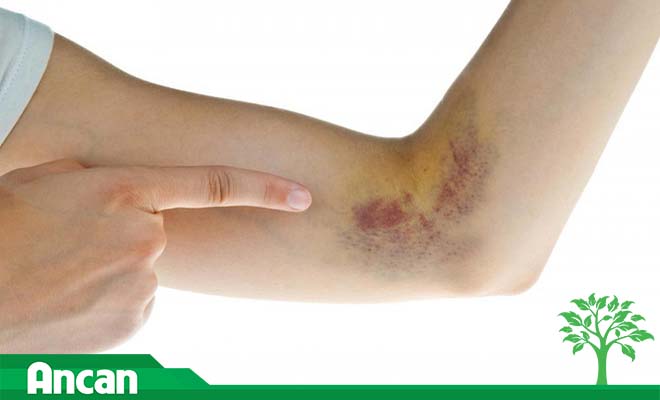 Khi có  4 dấu hiệu này hãy coi chừng trong cơ thể bạn đã xuất hiện tế bào ung thư