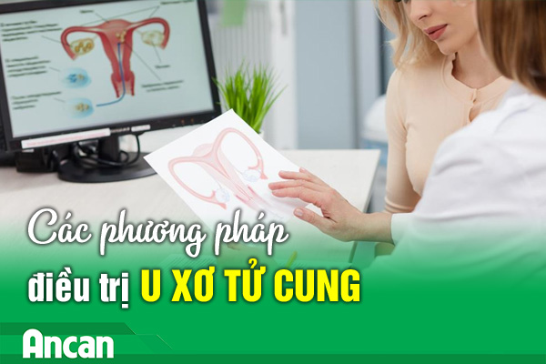 Bệnh u xơ tử cung và cách điều trị hiệu quả