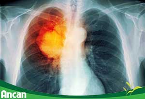 Tại sao ung thư phổi lại nguy hiểm nhất trong các loại ung thư?