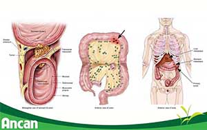 Triệu chứng ung thư đại tràng di căn