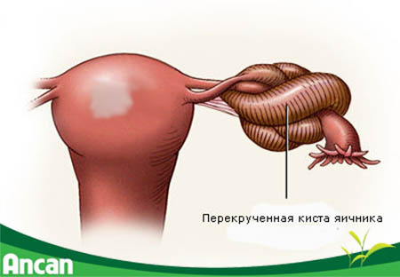 U nang buồng trứng xoắn - biến chứng nguy hiểm cần đề phòng