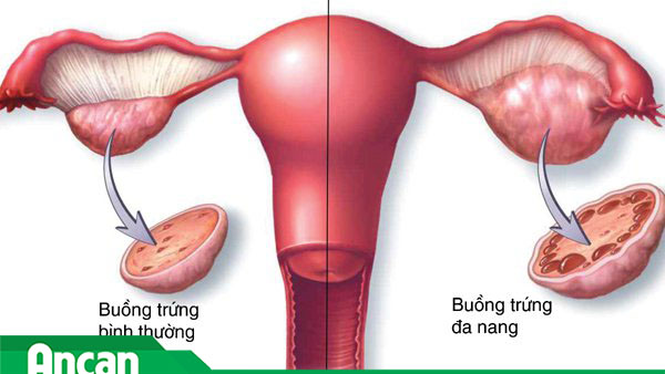 Những điều chị em cần biết về mổ u nang buồng trứng