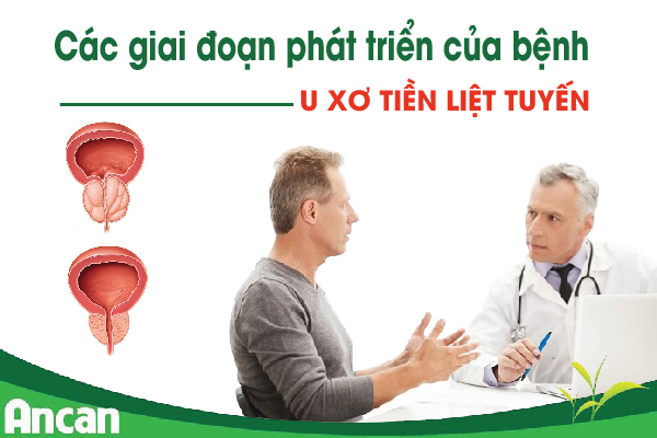 Các giai đoạn phát triển của bệnh u xơ tiền liệt tuyến