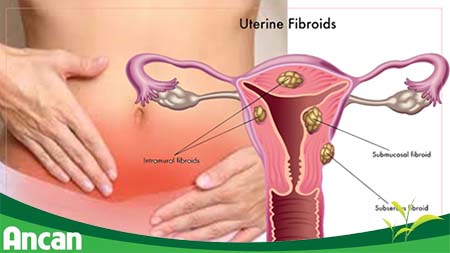 Các biến chứng nguy hiểm của bệnh u xơ tử cung