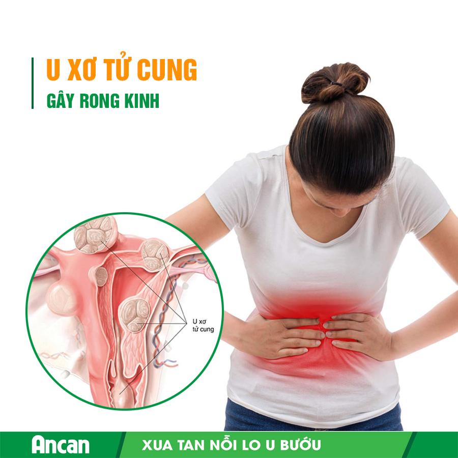 Rong kinh ở bệnh nhân u xơ tử cung