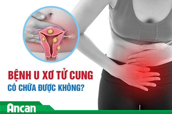 Bệnh u xơ tử cung có chữa được không?