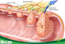 Ung thư đại tràng giai đoạn cuối sống được bao lâu?