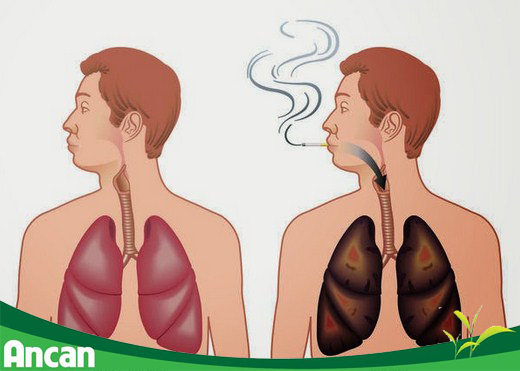 Ung thư phổi gây tử vong số 1 cho nam giới