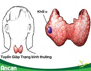 Ung thư tuyến giáp có chữa được không?