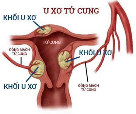 Ảnh hưởng của u xơ tử cung với khả năng sinh sản